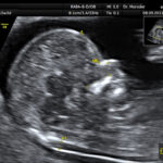 nuchal translucency scan